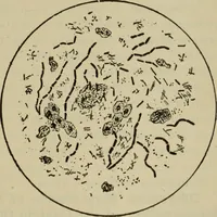 An illustration from The diagnostics of internal medicine : a clinical treatise upon the recognised principles of medical diagnosis, prepared for the use of students and practitioners of medicine / by Glentworth Reeve Butler ... ; with five coloured plates and two hundred and seventy-two illustrations and charts in the text. (1909)