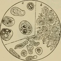 An illustration from The diagnostics of internal medicine : a clinical treatise upon the recognised principles of medical diagnosis, prepared for the use of students and practitioners of medicine / by Glentworth Reeve Butler ... ; with five coloured plates and two hundred and seventy-two illustrations and charts in the text. (1909)