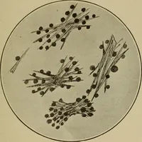 An illustration from The diagnostics of internal medicine : a clinical treatise upon the recognised principles of medical diagnosis, prepared for the use of students and practitioners of medicine / by Glentworth Reeve Butler ... ; with five coloured plates and two hundred and seventy-two illustrations and charts in the text. (1909)