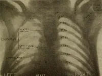 An illustration from The diagnostics of internal medicine : a clinical treatise upon the recognised principles of medical diagnosis, prepared for the use of students and practitioners of medicine / by Glentworth Reeve Butler ... ; with five coloured plates and two hundred and seventy-two illustrations and charts in the text. (1909)