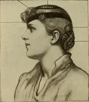 An illustration from The diagnostics of internal medicine : a clinical treatise upon the recognised principles of medical diagnosis, prepared for the use of students and practitioners of medicine / by Glentworth Reeve Butler ... ; with five coloured plates and two hundred and seventy-two illustrations and charts in the text. (1909)