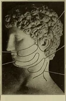 An illustration from The diagnostics of internal medicine : a clinical treatise upon the recognised principles of medical diagnosis, prepared for the use of students and practitioners of medicine / by Glentworth Reeve Butler ... ; with five coloured plates and two hundred and seventy-two illustrations and charts in the text. (1909)