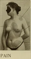 An illustration from The diagnostics of internal medicine : a clinical treatise upon the recognised principles of medical diagnosis, prepared for the use of students and practitioners of medicine / by Glentworth Reeve Butler ... ; with five coloured plates and two hundred and seventy-two illustrations and charts in the text. (1909)