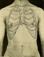 An illustration from Diseases of the heart and arterial system : designed to be a practical presentation of the subject for the use of students and practitioners of medicine / by Robert H. Babcock ; with three coloured plates and one hundred and thirty-nine illustrations. (1907)