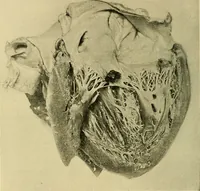 An illustration from Diseases of the heart and arterial system : designed to be a practical presentation of the subject for the use of students and practitioners of medicine / by Robert H. Babcock ; with three coloured plates and one hundred and thirty-nine illustrations. (1907)