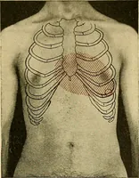 An illustration from Diseases of the heart and arterial system : designed to be a practical presentation of the subject for the use of students and practitioners of medicine / by Robert H. Babcock ; with three coloured plates and one hundred and thirty-nine illustrations. (1907)
