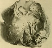 An illustration from Diseases of the heart and arterial system : designed to be a practical presentation of the subject for the use of students and practitioners of medicine / by Robert H. Babcock ; with three coloured plates and one hundred and thirty-nine illustrations. (1907)