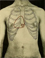An illustration from Diseases of the heart and arterial system : designed to be a practical presentation of the subject for the use of students and practitioners of medicine / by Robert H. Babcock ; with three coloured plates and one hundred and thirty-nine illustrations. (1907)