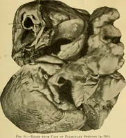 An illustration from Diseases of the heart and arterial system : designed to be a practical presentation of the subject for the use of students and practitioners of medicine / by Robert H. Babcock ; with three coloured plates and one hundred and thirty-nine illustrations. (1907)