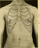 An illustration from Diseases of the heart and arterial system : designed to be a practical presentation of the subject for the use of students and practitioners of medicine / by Robert H. Babcock ; with three coloured plates and one hundred and thirty-nine illustrations. (1907)
