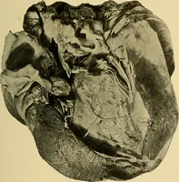 An illustration from Diseases of the heart and arterial system : designed to be a practical presentation of the subject for the use of students and practitioners of medicine / by Robert H. Babcock ; with three coloured plates and one hundred and thirty-nine illustrations. (1907)