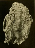 An illustration from Diseases of the heart and arterial system : designed to be a practical presentation of the subject for the use of students and practitioners of medicine / by Robert H. Babcock ; with three coloured plates and one hundred and thirty-nine illustrations. (1907)