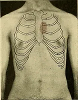 An illustration from Diseases of the heart and arterial system : designed to be a practical presentation of the subject for the use of students and practitioners of medicine / by Robert H. Babcock ; with three coloured plates and one hundred and thirty-nine illustrations. (1907)