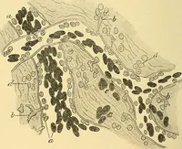An illustration from A text-book of pathology for students of medicine / by J. George Adami and John McCrae ; illustrated with 304 engravings and 11 colored plates. (1912)