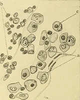 An illustration from A text-book of pathology for students of medicine / by J. George Adami and John McCrae ; illustrated with 304 engravings and 11 colored plates. (1912)
