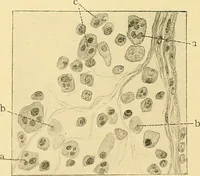 An illustration from A text-book of pathology for students of medicine / by J. George Adami and John McCrae ; illustrated with 304 engravings and 11 colored plates. (1912)