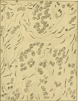 An illustration from A text-book of pathology for students of medicine / by J. George Adami and John McCrae ; illustrated with 304 engravings and 11 colored plates. (1912)