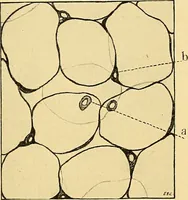 An illustration from A text-book of pathology for students of medicine / by J. George Adami and John McCrae ; illustrated with 304 engravings and 11 colored plates. (1912)