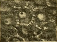 An illustration from A text-book of pathology for students of medicine / by J. George Adami and John McCrae ; illustrated with 304 engravings and 11 colored plates. (1912)