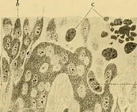 An illustration from A text-book of pathology for students of medicine / by J. George Adami and John McCrae ; illustrated with 304 engravings and 11 colored plates. (1912)