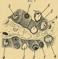 An illustration from A text-book of pathology for students of medicine / by J. George Adami and John McCrae ; illustrated with 304 engravings and 11 colored plates. (1912)