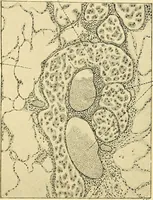 An illustration from A text-book of pathology for students of medicine / by J. George Adami and John McCrae ; illustrated with 304 engravings and 11 colored plates. (1912)