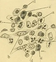 An illustration from A text-book of pathology for students of medicine / by J. George Adami and John McCrae ; illustrated with 304 engravings and 11 colored plates. (1912)