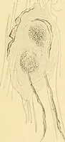 An illustration from A text-book of pathology for students of medicine / by J. George Adami and John McCrae ; illustrated with 304 engravings and 11 colored plates. (1912)