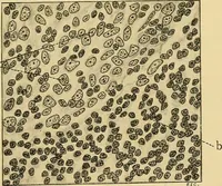 An illustration from A text-book of pathology for students of medicine / by J. George Adami and John McCrae ; illustrated with 304 engravings and 11 colored plates. (1912)