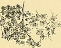 An illustration from A text-book of pathology for students of medicine / by J. George Adami and John McCrae ; illustrated with 304 engravings and 11 colored plates. (1912)