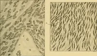 An illustration from A text-book of pathology for students of medicine / by J. George Adami and John McCrae ; illustrated with 304 engravings and 11 colored plates. (1912)