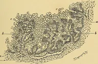 An illustration from A text-book of pathology for students of medicine / by J. George Adami and John McCrae ; illustrated with 304 engravings and 11 colored plates. (1912)