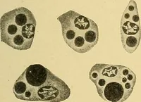 An illustration from A text-book of pathology for students of medicine / by J. George Adami and John McCrae ; illustrated with 304 engravings and 11 colored plates. (1912)