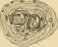 An illustration from A text-book of pathology for students of medicine / by J. George Adami and John McCrae ; illustrated with 304 engravings and 11 colored plates. (1912)