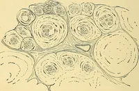 An illustration from A text-book of pathology for students of medicine / by J. George Adami and John McCrae ; illustrated with 304 engravings and 11 colored plates. (1912)