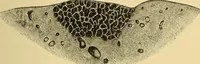 An illustration from A text-book of pathology for students of medicine / by J. George Adami and John McCrae ; illustrated with 304 engravings and 11 colored plates. (1912)