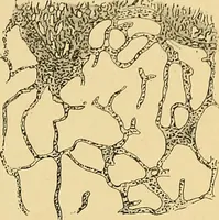 An illustration from A text-book of pathology for students of medicine / by J. George Adami and John McCrae ; illustrated with 304 engravings and 11 colored plates. (1912)