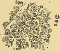 An illustration from A text-book of pathology for students of medicine / by J. George Adami and John McCrae ; illustrated with 304 engravings and 11 colored plates. (1912)