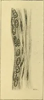 An illustration from A text-book of pathology for students of medicine / by J. George Adami and John McCrae ; illustrated with 304 engravings and 11 colored plates. (1912)