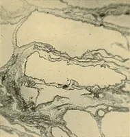 An illustration from A text-book of pathology for students of medicine / by J. George Adami and John McCrae ; illustrated with 304 engravings and 11 colored plates. (1912)