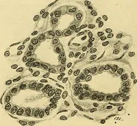An illustration from A text-book of pathology for students of medicine / by J. George Adami and John McCrae ; illustrated with 304 engravings and 11 colored plates. (1912)