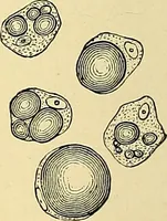 An illustration from A text-book of pathology for students of medicine / by J. George Adami and John McCrae ; illustrated with 304 engravings and 11 colored plates. (1912)