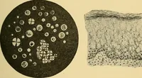 An illustration from A text-book of pathology for students of medicine / by J. George Adami and John McCrae ; illustrated with 304 engravings and 11 colored plates. (1912)