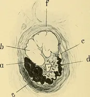 An illustration from A text-book of pathology for students of medicine / by J. George Adami and John McCrae ; illustrated with 304 engravings and 11 colored plates. (1912)