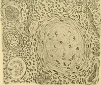 An illustration from A text-book of pathology for students of medicine / by J. George Adami and John McCrae ; illustrated with 304 engravings and 11 colored plates. (1912)