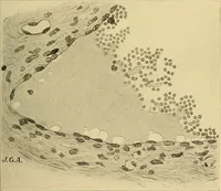 An illustration from A text-book of pathology for students of medicine / by J. George Adami and John McCrae ; illustrated with 304 engravings and 11 colored plates. (1912)