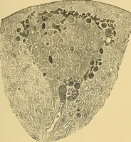 An illustration from A text-book of pathology for students of medicine / by J. George Adami and John McCrae ; illustrated with 304 engravings and 11 colored plates. (1912)