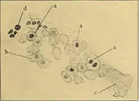 An illustration from A text-book of pathology for students of medicine / by J. George Adami and John McCrae ; illustrated with 304 engravings and 11 colored plates. (1912)