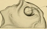 An illustration from A text-book of pathology for students of medicine / by J. George Adami and John McCrae ; illustrated with 304 engravings and 11 colored plates. (1912)