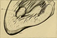 An illustration from A text-book of pathology for students of medicine / by J. George Adami and John McCrae ; illustrated with 304 engravings and 11 colored plates. (1912)